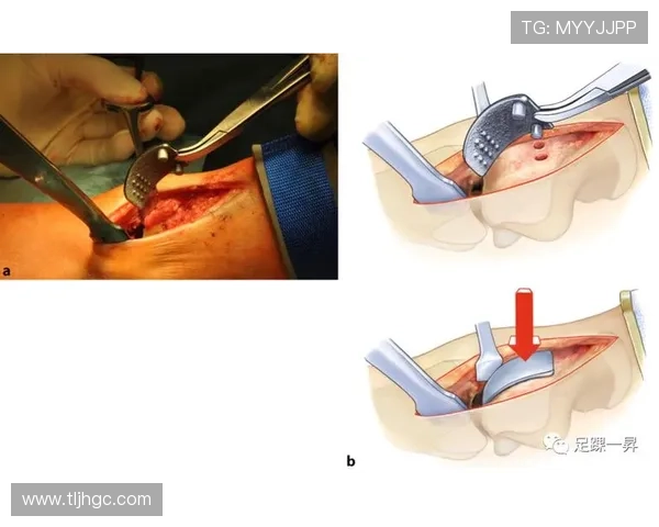 足球明星踝关节置换手术背后的故事与康复之路探秘